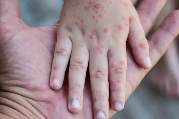 Puebla registra 29 brotes de Coxsackie